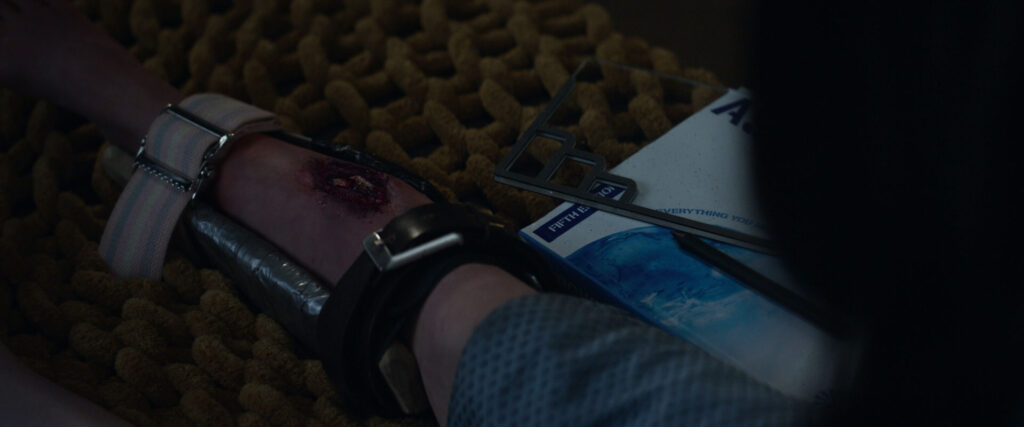 A child’s leg in a brace, showing a wound on her leg. A pink/blue/pink/white/pink/blue/pink strap is buckled around the brace.